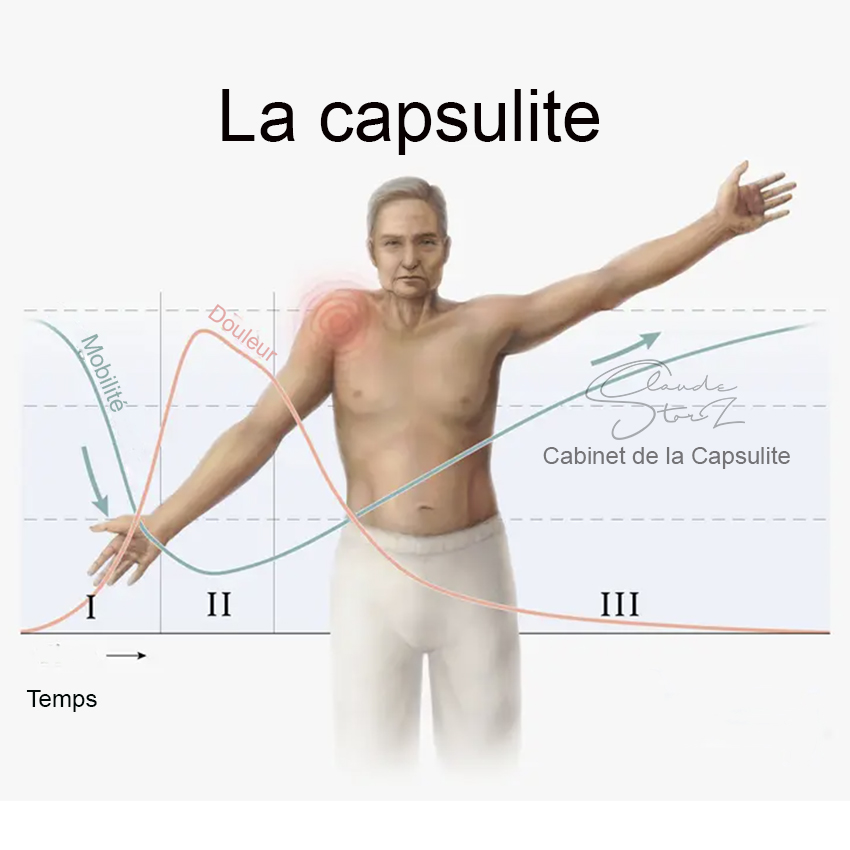 La capsulite - Spécialiste de la capsulite et de la tendinite